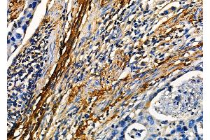 ABIN7093915 and ABIN7097959 at 1/100 staining Human colorectal cancer by IHC-P.