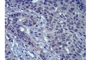 Immunohistochemical analysis of paraffin-embedded esophageal cancer tissues using LEF1 mouse mAb with DAB staining. (LEF1 anticorps  (AA 33-138))