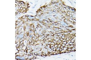 Immunohistochemistry of paraffin-embedded Human cervical squamous cell carcinoma using MUC1 Rabbit mAb (ABIN7268687) at dilution of 1:100 (40x lens). (MUC1 anticorps)