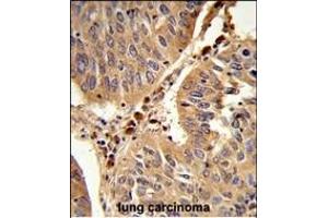 Formalin-fixed and paraffin-embedded human lung carcinoma reacted with PEX16 Antibody (Center), which was peroxidase-conjugated to the secondary antibody, followed by DAB staining. (PEX16 anticorps  (AA 247-275))