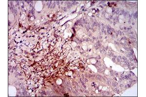 Immunohistochemical analysis of paraffin-embedded rectum cancer tissues using ILK mouse mAb with DAB staining. (ILK anticorps  (AA 97-244))