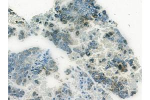ABIN6265247 and ABIN6272432 at 1/100 staining human melanoma by IHC-P. (Sp3/4 anticorps  (C-Term))