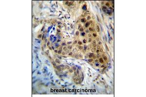 RPL3 Antibody (Center) (ABIN657323 and ABIN2846397) immunohistochemistry analysis in formalin fixed and paraffin embedded human breast carcinoma followed by peroxidase conjugation of the secondary antibody and DAB staining.
