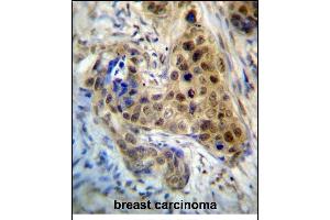 RPL3 Antibody (Center) (ABIN657323 and ABIN2846397) immunohistochemistry analysis in formalin fixed and paraffin embedded human breast carcinoma followed by peroxidase conjugation of the secondary antibody and DAB staining. (RPL3 anticorps  (AA 224-251))