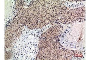 Immunohistochemistry (IHC) analysis of paraffin-embedded Human Breast Cancer, antibody was diluted at 1:100.