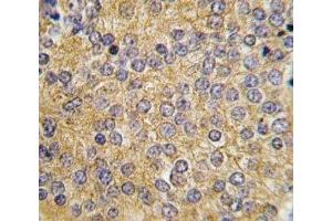 IHC analysis of FFPE human prostate carcinoma tissue stained with Urokinase antibody