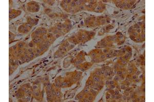 IHC image of ABIN7147846 diluted at 1:200 and staining in paraffin-embedded human breast cancer performed on a Leica BondTM system. (Clathrin Heavy Chain (CLTC) (AA 851-990) anticorps)