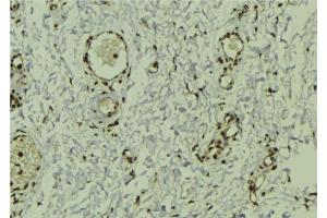 ABIN6272941 at 1/100 staining Human breast cancer tissue by IHC-P. (DEK anticorps  (Internal Region))
