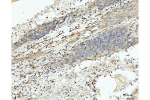 IHC analysis of MT-ND5 using anti-MT-ND5 antibody (ABIN7600145). (MT-ND5 anticorps  (AA 154-570))