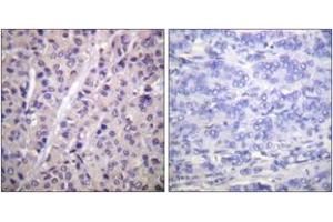 Immunohistochemistry analysis of paraffin-embedded human breast carcinoma, using A-RAF (Phospho-Tyr302) Antibody. (ARAF anticorps  (pTyr302))