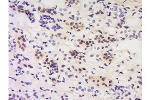 Formalin-fixed and paraffin embedded human kidney labeled with Anti-Calcipressin 1/DSCR 1 Polyclonal Antibody, Unconjugated  at 1:200 followed by conjugation to the secondary antibody and DAB staining. (RCAN1 anticorps  (AA 101-200))