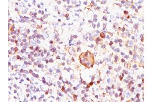 Formalin-fixed, paraffin-embedded Hodgkin's lymphoma stained with Bcl-x Mouse Monoclonal Antibody (BX006). (BCL2L1 anticorps  (AA 3-14))
