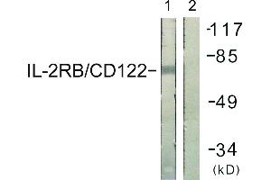 Immunohistochemistry analysis of paraffin-embedded human lung carcinoma tissue using IL-2Rβ/CD122 (Ab-364) antibody. (IL2 Receptor beta anticorps)