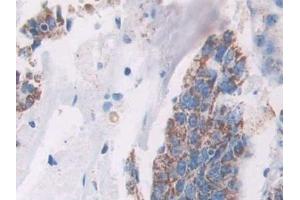 Detection of AGR2 in Human Colorectal cancer Tissue using Monoclonal Antibody to Anterior Gradient 2 (AGR2) (AGR2 anticorps  (AA 21-175))