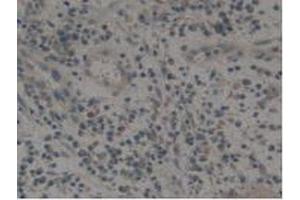 IHC-P analysis of Human Skin Cancer Tissue, with DAB staining. (Tissue factor anticorps  (AA 34-251))
