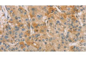 Immunohistochemistry of paraffin-embedded Human liver cancer tissue using CENPF Polyclonal Antibody at dilution 1:40 (CENPF anticorps)