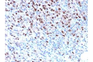 Formalin-fixed, paraffin-embedded human Melanoma stained with MITF Recombinant Rabbit Monoclonal Antibody (MITF/2987R). (Recombinant MITF anticorps)