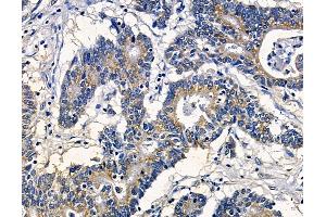 ABIN7095031 and ABIN7099087 at 1/100 staining human colorectal cancer by IHC-P. (SRGAP2 anticorps)