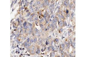 ABIN6266804 at 1/100 staining human ovarian cancer tissue sections by IHC-P. (MUC13 anticorps  (C-Term))