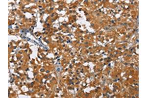 The image on the left is immunohistochemistry of paraffin-embedded Human thyroid cancer tissue using ABIN7130004(KLF7 Antibody) at dilution 1/60, on the right is treated with fusion protein. (KLF7 anticorps)