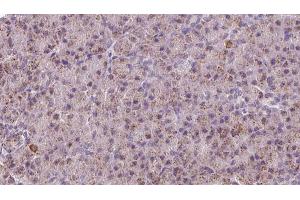 ABIN6273219 at 1/100 staining Human pancreas cancer tissue by IHC-P. (CTNNA3 anticorps  (Internal Region))