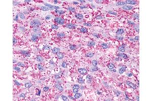 Anti-P2Y13 / P2RY13 antibody IHC of human Brain, Glioblastoma.