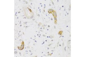 Immunohistochemistry of paraffin-embedded human liver cancer using PCM1 Antibody (ABIN1876897) at dilution of 1:100 (40x lens). (PCM1 anticorps)