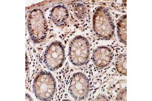 Immunohistochemical analysis of TSSK6 staining in human colon cancer formalin fixed paraffin embedded tissue section. (TSSK6 anticorps)