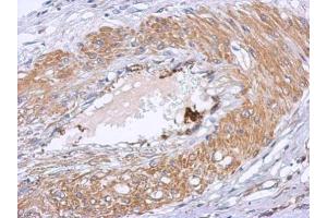IHC-P Image Immunohistochemical analysis of paraffin-embedded human gastric cancer, using Dystrobrevin beta, antibody at 1:500 dilution. (Dystrobrevin beta anticorps)