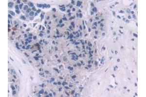 Detection of IL2 in Human Prostate cancer Tissue using Polyclonal Antibody to Interleukin 2 (IL2) (IL-2 anticorps  (AA 21-153))