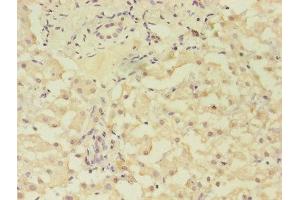 Immunohistochemistry of paraffin-embedded human liver cancer using ABIN7153293 at dilution of 1:100 (GRK4 anticorps  (AA 1-245))