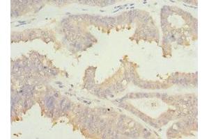 Immunohistochemistry of paraffin-embedded human prostate cancer using ABIN7172902 at dilution of 1:100