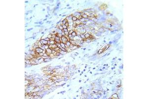 Immunohistochemical analysis of paraffin- embedded human lung adenocarcinoma tissue using FGFR1 (Ab-154) Antibody (E022077). (FGFR1 anticorps)