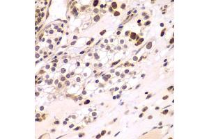 Immunohistochemistry of paraffin-embedded human kidney cancer using CEBPG antibody (ABIN5974381) at dilution of 1/100 (40x lens). (CEBPG anticorps)