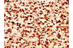 IHC image of nforHU diluted at 1:50 and staining in paraffin-embedded human glioma performed on a Leica BondTM system. (HIST1H1C anticorps)