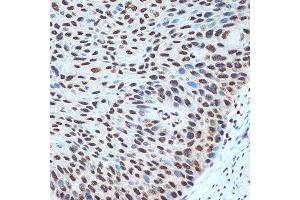 Immunohistochemistry of paraffin-embedded human esophageal cancer using Histone H2B Rabbit mAb (ABIN7267736) at dilution of 1:100 (40x lens).