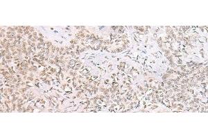Immunohistochemistry of paraffin-embedded Human ovarian cancer tissue using SMNDC1 Polyclonal Antibody at dilution of 1:50(x200) (SMNDC1 anticorps)