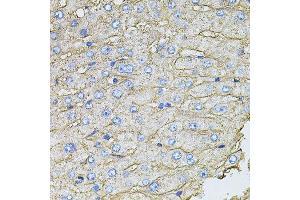 Immunohistochemistry of paraffin-embedded human liver injury using SLC2A2 antibody (ABIN6003575) at dilution of 1/100 (40x lens). (SLC2A2 anticorps)