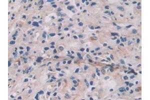 Detection of IL12A in Human Prostate cancer Tissue using Monoclonal Antibody to Interleukin 12A (IL12A)