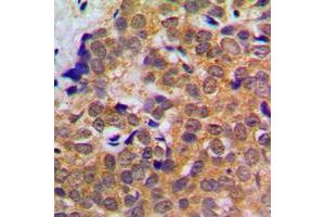 Immunohistochemical analysis of STAT5 staining in human breast cancer formalin fixed paraffin embedded tissue section.