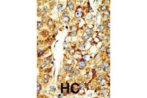 Formalin-fixed and paraffin-embedded human hepatocellular carcinoma tissue reacted with the SETD8 polyclonal antibody  , which was peroxidase-conjugated to the secondary antibody, followed by DAB staining. (SETD8 anticorps  (AA 25-53))