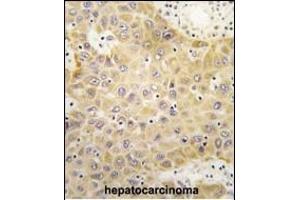 Formalin-fixed and paraffin-embedded human hepatocarcinoma tissue reacted with GRK5 Antibody (C-term) (ABIN390988 and ABIN2841171) , which was peroxidase-conjugated to the secondary antibody, followed by DAB staining.