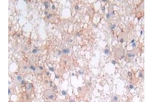 Detection of LIF in Human Glioma Tissue using Polyclonal Antibody to Leukemia Inhibitory Factor (LIF)