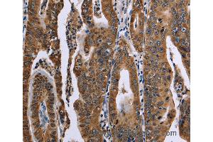 Immunohistochemistry of Human gastric cancer using FAF1 Polyclonal Antibody at dilution of 1:50 (FAF1 anticorps)