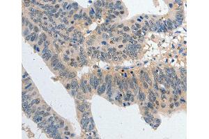 Immunohistochemistry of paraffin-embedded human colon cancer tissue, using P2RY6 antibody.