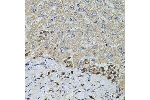 Immunohistochemistry of paraffin-embedded human liver injury using S100A12 antibody. (S100A12 anticorps  (AA 1-92))