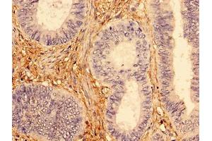 Immunohistochemistry of paraffin-embedded human colon cancer using ABIN7173954 at dilution of 1:100 (INPP5A anticorps  (AA 1-409))