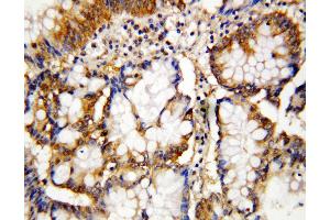 Anti-Caspase-10 antibody, IHC(P) IHC(P): Human Intestinal Cancer Tissue (Caspase 10 anticorps  (N-Term))