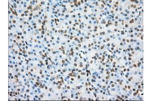 Immunohistochemical staining of paraffin-embedded Adenocarcinoma of Human colon tissue using anti-PDE4A mouse monoclonal antibody. (PDE4A anticorps)