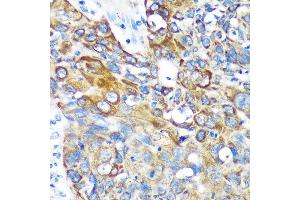 Immunohistochemistry of paraffin-embedded Human lung cancer using KIF17 Rabbit pAb (ABIN7268123) at dilution of 1:100 (40x lens). (KIF17 anticorps  (AA 360-660))